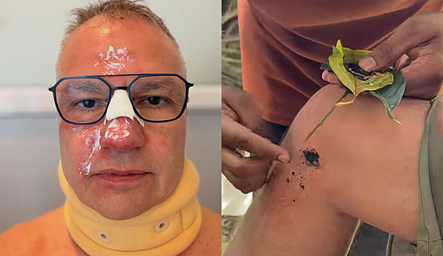 Sidovského s Vítkem potrápily na Srí Lance tropické pijavice i přeražený nos